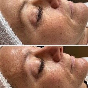 Hydrafacial-vorher-nachher-Behandlungen-Heimann-Kosmetik