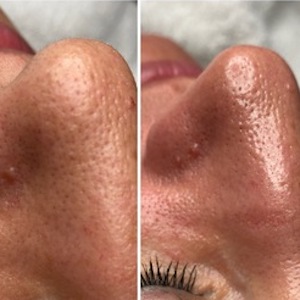 Hydrafacial-vorher-nachher-Behandlungen-Heimann-Kosmetik